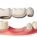 An illustration of a dental bridge
