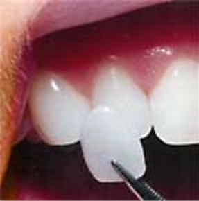 A porcelain veneer being placed on teeth