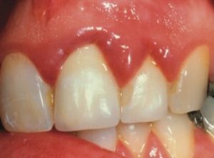 Thickened gums as a result of poorly made dental crowns