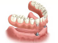 Implant overdenture illustration of ball-shaped snap fixture