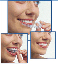 Woman placing Invisalign on her teeth