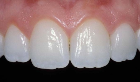 natural looking porcelain veneers