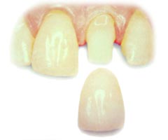 tooth prepared for a dental crown