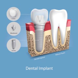 Image of dental implant beside a natural tooth