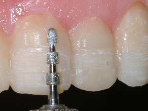 Teeth being prepared for porcelain veneers