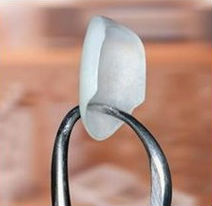 A single porcelain veneer