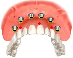 image of implant overdentures