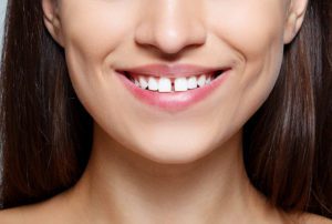 Woman with a gapped tooth