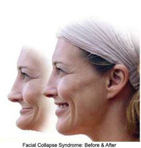 before and after facial collapse image