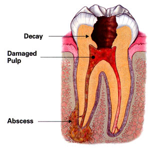 An illustration of a tooth that needs a root canal treatment.